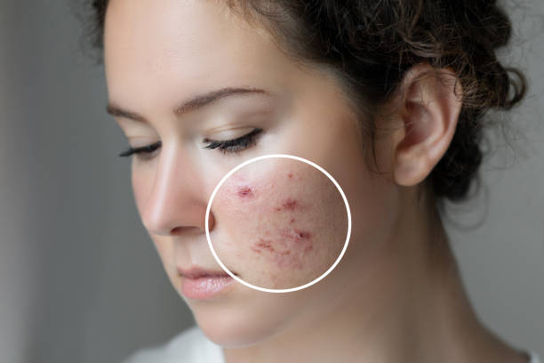 Treatments for acne scars using advanced skin therapies at OC Weight Loss and MedSpa