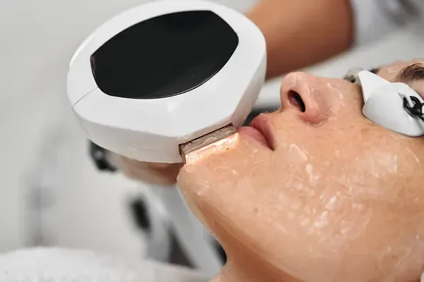 IPL photofacial benefits — handpiece on cheek for sun damage and redness