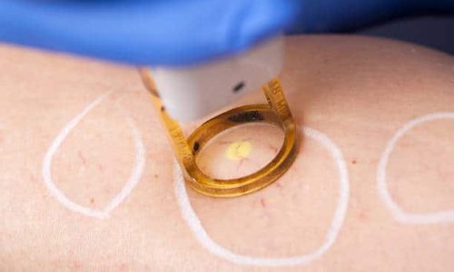 Removal of spider veins on the leg by laser treatment.