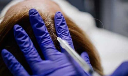 PRP (platelet-rich plasma) therapy for hair loss