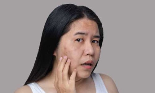 acne mark