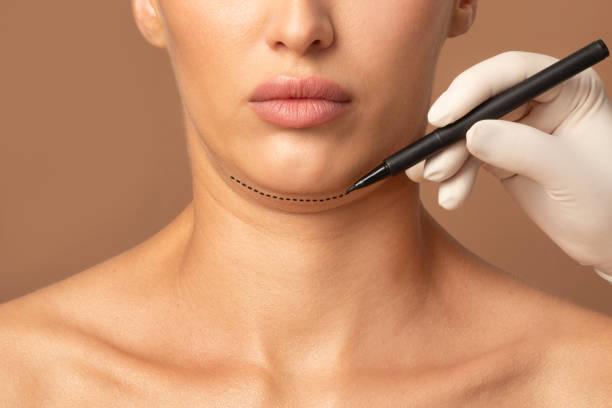 Double chin reduction using non-surgical fat reduction treatments at OC Weight Loss and MedSpa