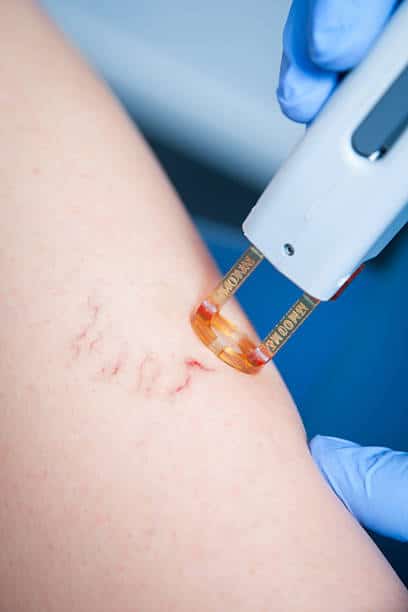 Laser vein removal treatment for spider veins and broken capillaries at OC Weight Loss and MedSpa