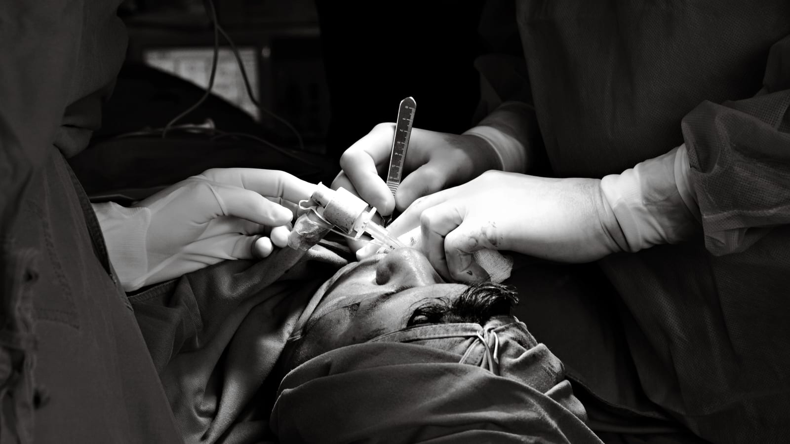 Syringe and cannula on a sterile field in a clinic — lip filler in newport beach at OC Weight Loss & Med Spa, Mission Viejo