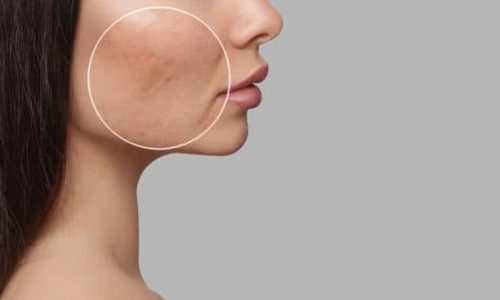 pores