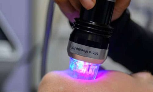 rf for face contouring