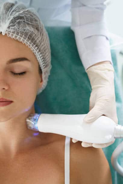 RF microneedling for fat reduction and skin contouring at OC Weight Loss and MedSpa