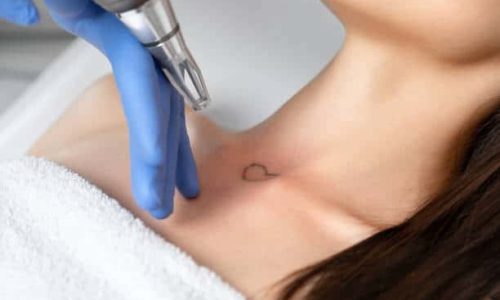 tatoo removal
